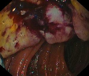Endoscopic view of the tumor through the enteroscope, showing the intestinal lumen with a darkened, ulcerated, friable mass in the upper zone.