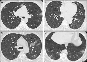 Sequential computed tomography scans performed in the three cases. A) Case 1: CT scan shows multiple ground-glass opacities (GGOs) in the upper and lower lobes, with bilateral and peripheral distribution. Some GGOs can also be seen next to the left hilum. These image findings are typical of SARS-CoV-2 pneumonia. B) Case 2: The initial CT scan shows subtle GGOs in the inferior right lobe. In the first follow-up scan, new areas of GGOs are visible in the superior left lobe. C) Case 2: The second CT scan shows that the GGOs increased in size, number, and density. Bilateral involvement is present (not shown). D) Case 3: The CT scan shows a single subpleural GGO. Multiple areas of ground-glass opacities with the classic COVID-19 appearance can be seen, as well as some linear opacities associated with the GGOs.