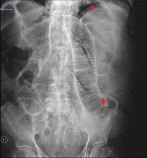 Plain abdominal x-ray showing gastric dilation with intramural gas (arrows) and small bowel segment dilation.