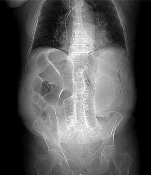 Luminogram from an abdominal CT scan with iv contrast medium. Intraparietal gas forming a dilated gastric silhouette is shown, as well as the bowel segment dilation.