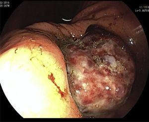 Endoscopic image, in which the tumor invading the gastric antrum is identified on retroflexion.