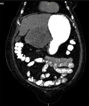 Coronal view of the abdominal CAT scan, showing the liver tumor invading the stomach.