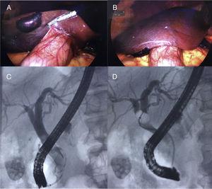 (A and B) Laparoscopic view of the subcapsular hematoma, as an intraoperative finding. (C and D) Image of the cholangiography during the ERCP.