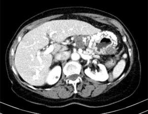 Transversal view showing the thickened and calcified gastric wall.