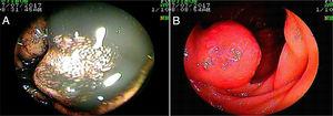 Well differentiated neuroendocrine tumor. A) VCE, B) Antegrade double balloon enteroscopy.