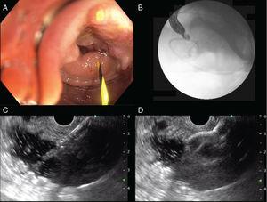A) Advance of the hydrophilic guidewire through the malignant duodenal stricture. B) Fluoroscopy-guided placement of the nasobiliary drainage catheter in front of the angle of Treitz. C) Endoscopic ultrasound-guided puncture of the targeted segment. D) Release of the first flange of the lumen-apposing stent.