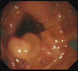 Polyp detected by the Endocuff-assisted technique.