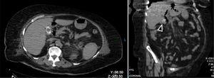 Axial and coronal views of non-contrast abdominal computed tomography scan showing the stone within the gallbladder.