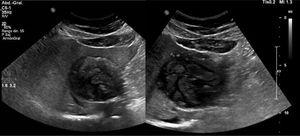 Complementary liver ultrasound study was performed.