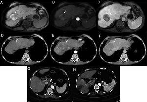 Case 1) Magnetic resonance imaging (MRI): T1 FatSat image shows hyperintensity of the tumor in segment VII secondary to necrosis with no arterial enhancement and no new lesions observed in the venous phase (a-c). The tumor seen on the previous MRI now shows activity and an increase in size (d-f). Case 2) Computed tomography (CT): 7 mm lesion with enhancement and a 17 mm lesion with typical behavior (g). Control image 2 months post-radiofrequency ablation shows the increase in size of the lesion from 7 mm to 25 mm, with a typical image of HCC (h).