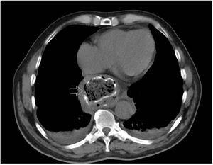 Axial view of the chest CT scan. The arrow indicates the esophageal diverticulum filled with foreign bodies, in close contact with the pericardium.