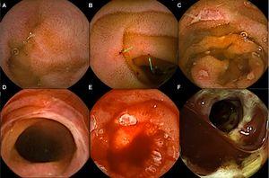 Capsule endoscopy images of the small bowel in patients with gastrointestinal graft-versus-host disease. a) diffuse erythema and red spots; b) punched-out ulcers; c) fibrin-covered ulcers; d) sloughing of the mucosa; e) denuded mucosa and active bleeding; f) ulcerated stricture.