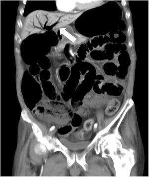 Contrast-enhanced abdominal computed tomography scan, showing the expanded intestinal tract and portal emphysema (arrow).