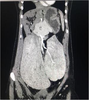 Coronal view of the abdominal-pelvic tomography scan in the contrast-enhanced arterial phase showing the pelvic location of the liver, with the presence of a Riedel lobe.