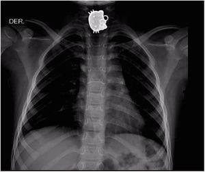 Metallic object in the upper third of the esophagus.