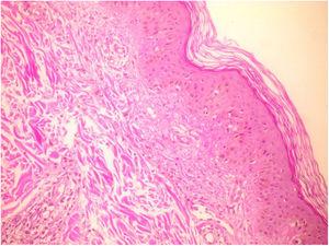 Biopsy of skin lesions showing leukocytoclastic vasculitis (hematoxylin and eosin stain [H&E], ×20).