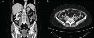 (A) and (B) Coronal and axial views of abdominal CT scans with intravenous contrast medium, showing a diverticular formation of approximately 11mm in the terminal ileum, with inflammatory changes in the adjacent fat and adjacent layers of free fluid, suggestive of diverticulitis.