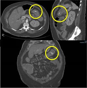 Abdominal CT angiography: active intraluminal bleeding of the left colic artery, with contrast medium extravasation (circle).