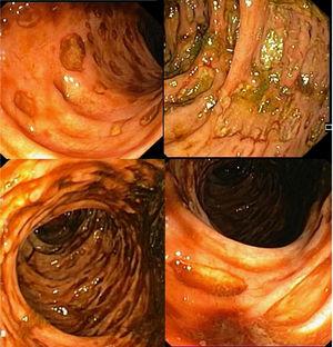 Colonoscopy: extensive punched-out ulcer lesions distributed from the sigmoid colon to the cecum.