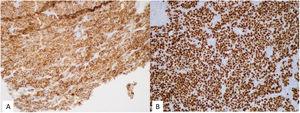 Immunohistochemistry: A) Positive cytoplasmic staining for Melan-A (x40). B) Positive nuclear staining for SOX-10 (x20).