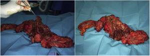 Surgical specimen, after the sigmoidectomy and Hartmann procedure, with multiple worm-like polyps.