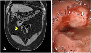 A) CT coronal view, showing the dumbbell-shaped lesion (arrow) of the transverse colon. B) Colonoscopic image, showing a friable and strictured lesion.