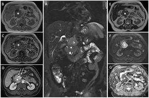 Coronal and axial T2W MRI scans, showing a mass in the pancreatic head (A-E-asterisk), with intermediate signal intensity, accompanied by peripancreatic lymphadenopathy just superior to the mass, demonstrating slightly less signal intensity than the mass (A-arrowhead). The mass shows hypointense signal characteristics on the non-contrast T1W in-phase and out-of-phase MRI scans (B-C) and demonstrates subtle contrast enhancement (D-asterisk). Note the patency of the superior mesenteric artery and the splenic vein (D-short arrows) and the slightly dilated ductus pancreaticus on the post-contrast T1W image (D-long arrows). Lastly, axial DWI and corresponding ADC images show homogeneous diffusion restriction of the primary mass (F-G-asterisk).
