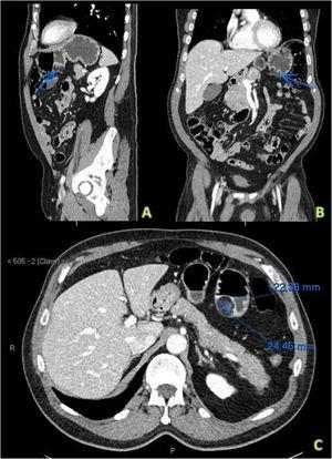 Sagittal view (A), coronal view (B), and axial view (C) of intravenous contrast-enhanced abdominopelvic CT images. A) Sagittal view, in which the arrow points to a round and well delineated lesion, dependent on the greater curvature of the stomach and close to the antrum. Its density is similar to that of fat, the lesion is non-enhancing, and it is consistent with an ulcerated lipoma. B) Coronal view, in which the fat density in the interior of the same gastric lesion is subtly increased (ulcerated tract). C) Axial view, showing the measurements of the lipomatous lesion to be approximately 22.4 × 24.5 mm.