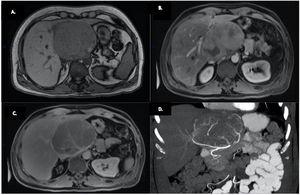 A) Gadolinium-contrasted magnetic resonance imaging, showing a heterogeneous 10×9×10cm hepatic mass located at the caudate lobe, out of phase, hypointense in the T1-weighted images and isointense in the T2-weighted images. B) Arterial phase enhancement. C) Washout in the portal venous delayed phase. D) Coronal view of the CT scan. A 10cm tumor is visualized on the caudate lobe, in close relation to the right and left gastric arteries.