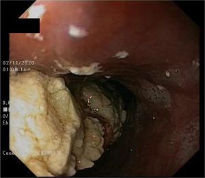 Endoscopic view of the proximal esophagus with food remnants that allowed passage of the endoscope.