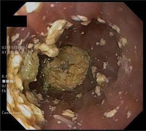 Endoscopic view of the yellowish bezoar causing complete esophageal obstruction.