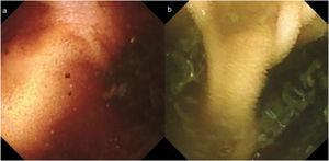 Digital photos from the capsule endoscopy showing a double-lumen image consistent with a small bowel diverticulum (a and b).