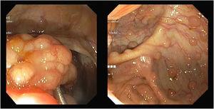 Cecal lymphomatous polyposis in white-light endoscopy.