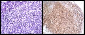 Population of small lymphoid cells (×100) (left side) and cyclin D1 immunostaining showing nuclear expression in the cells (×100) (right side).