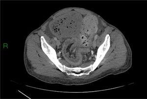 Abdominal CT scan showing a colorectal intussusception.