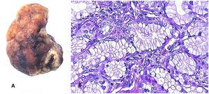 (A) Macroscopic description: a dark brown duodenal polyp with a wrinkled surface and 4 × 2 × 2 cm nodular formation. (B) Microscopic description: nodular proliferation of Brunner’s glands that includes stroma and ducts.