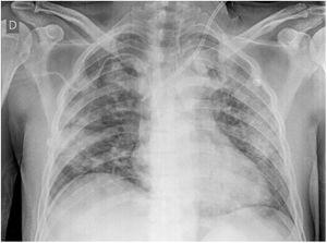 Chest x-ray taken on hospitalization day 6: diffuse alveolar pattern.
