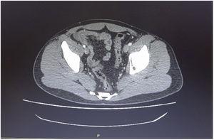 Abdominal CT scan, showing a segment (15 cm in extension) with marked circumferential bowel wall thickening (6 mm thickness) of the terminal ileum.