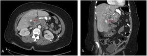 Follow-up computed tomography scans. A) Axial and B) coronal views showing the increased size of the hyperdense intraluminal focus (red arrows) in the region of the gallbladder fossa 5 days after the previous imaging, consistent with pseudoaneurysm.