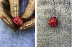 Cystic artery pseudoaneurysm resected intraoperatively.