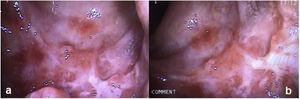 (a, b) Control proctoscopy showing the healing process of the ulcers in the distal rectum.
