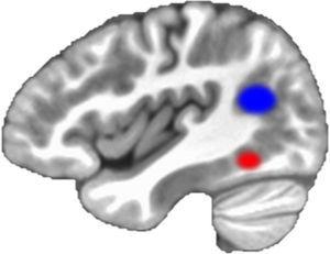 Área da forma visual das palavras (círculo vermelho) e região temporoparietal (círculo azul): marcadores cerebrais do desenvolvimento da leitura.