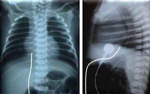 Percurso do cateter venoso umbilical em uma radiografia de tórax, em incidência anteroposterior (à esquerda) e lateral (à direita).