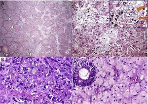 Alguns aspectos histológicos do fígado e duodeno no paciente n° 4. A – Cirrose micronodular avançada observada no explante do fígado (H&E, 25X); B – Essa área (do explante do fígado) descreve esteatose microvesicular e mediovesicular em muitos hepatócitos e grupos de células de Kupffer xantomatosas em sinusoides (H&E, 200X), além de raras fendas em forma de agulha (setas) dentro das células de Kupffer na inserção; C – Muitos macrófagos no trato portal mostram citoplasma xantomatoso no enxerto hepático após sete anos de transplante de fígado (H&E, 400X); D – A lâmina própria é infiltrada intensamente por grandes células espumosas carregadas de lipídios nessa biópsia duodenal (H&E, 400X).