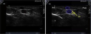 Ultralydsafbildning af nerven saphenus. SN: Nervus saphenus; GSV: Vena saphenus major; T: Tibia.