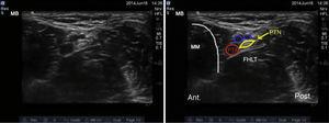 Imagistica ecografică a nervului tibial. PTN: nervul tibial posterior; PTA: artera tibială posterioară; MM: maleola medială; FHLT: tendonul flexor hallucis longus.