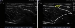 Ultraschalldarstellung des Nervus peroneus superficialis. SPN: oberflächlicher Peroneusnerv; EDL: extensor digitorum longus; PL: peroneus longus; F: Fibula.