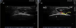 Ultrasuoni del nervo peroneo profondo. DPN: nervo peroneo profondo; ATA: arteria tibiale anteriore; EDL: extensor digitorum longus; T: tibia.