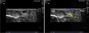 Ultrasound imaging of the sural nerve. SN: nervus suralis; LSV: kleine ader saphenus; F: fibula; PS: peroneale schede.