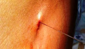 Epidural catheter removal by one of the anesthesiologists, showing resistance and skin lump.